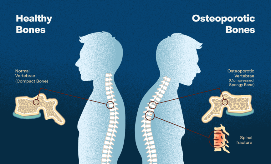 Calcium Deficiency; osteoporosis